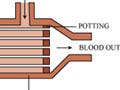 An illustration of a hollow fiber membrane hemodialyzer.  The illustration calls out important features of the device as well as the indicating the flow of fluids.