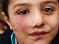 A photograph of two children in Gaza City – one child has visible stitches under his nose and across his cheek.