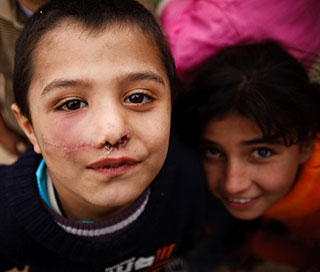 A photograph of two children in Gaza City – one child has visible stitches under his nose and across his cheek.