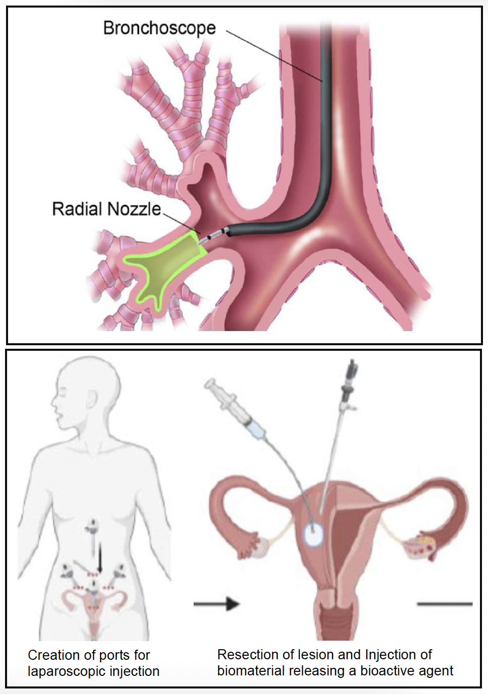 Design Projects Design Of Medical Devices And Implants Mechanical 