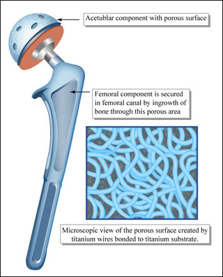 Drawing of hip implant, highlighting porous surfaces for tissue ingrowth.