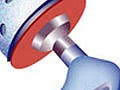 Drawing of hip implant, highlighting porous surfaces for tissue ingrowth.