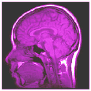 A brain scan image.