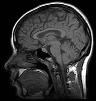 MRI image of a human head