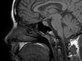 MRI image of a human head