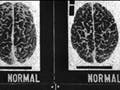 Set of photographs of brains labeled 'normal' and 'criminal'.