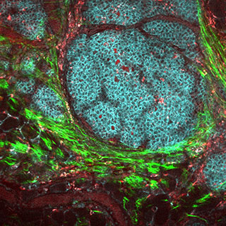 A breast cancer tumor and its surrounding tissue, as seen under a microscope. The tumor is a round mass of blue-green cells, dotted with tiny red circles, and surrounded by bright green fibers.