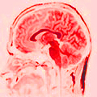 A red tinted MRI of an adult human brain.  