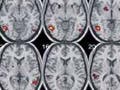 fMRI image showing right and left side brain activations.