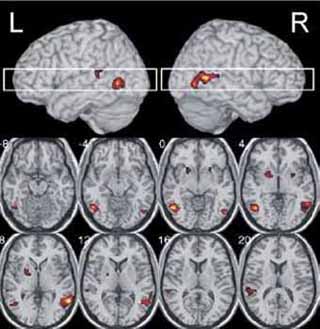 fMRI image showing right and left side brain activations.