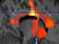 Statistically-analyzed PET scan data superimposed on structural MRI scan.