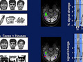 Comparison of sample fMRI scans of the brains of subjects.