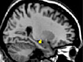 The hippocampus during conscious remembering of the past relative to memory based on stimulus familiarity.
