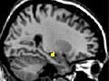 The hippocampus during conscious remembering of the past relative to memory based on stimulus familiarity.