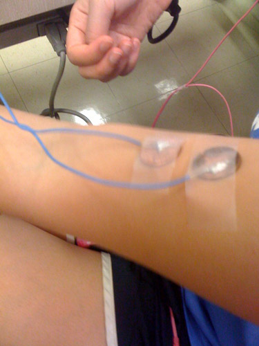  A photo showing electrodes taped to the arm.