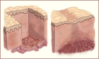 Two cross-section diagrams of skin, showing injury and scarred healing.