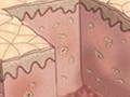 Two cross-section diagrams of skin, showing injury and scarred healing.