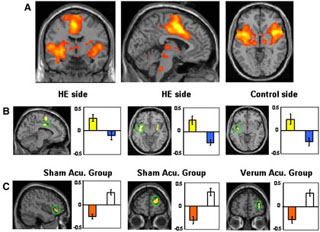 fMRI images and bar charts comparing responses to verum and sham acupuncture treatments.