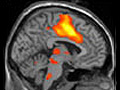 fMRI images and bar charts comparing responses to verum and sham acupuncture treatments.